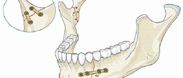 Остеосинтез челюстного сустава